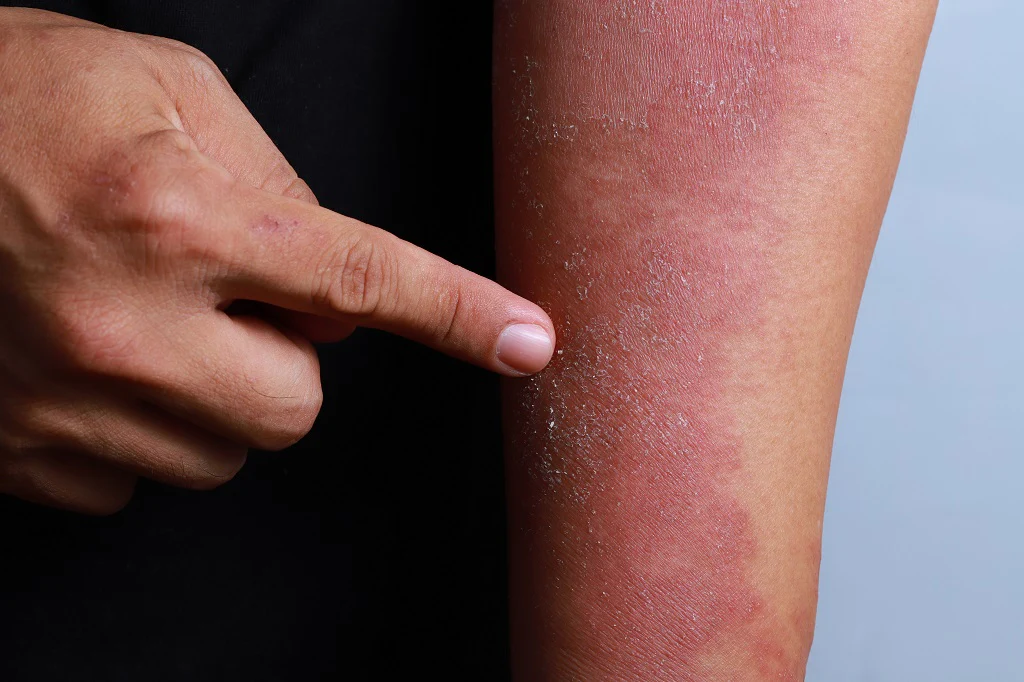Severe Infections