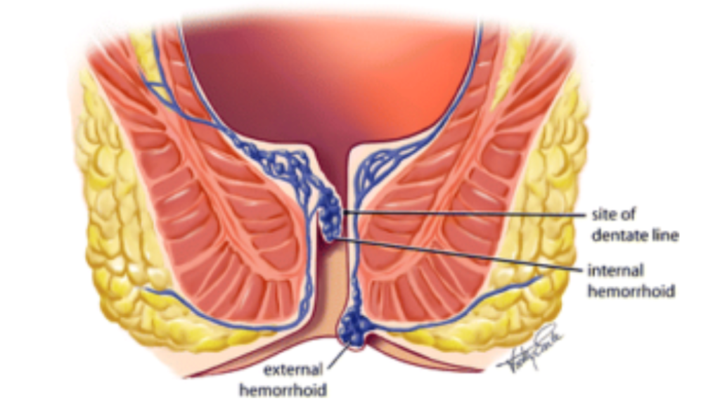 Hemorrhoids