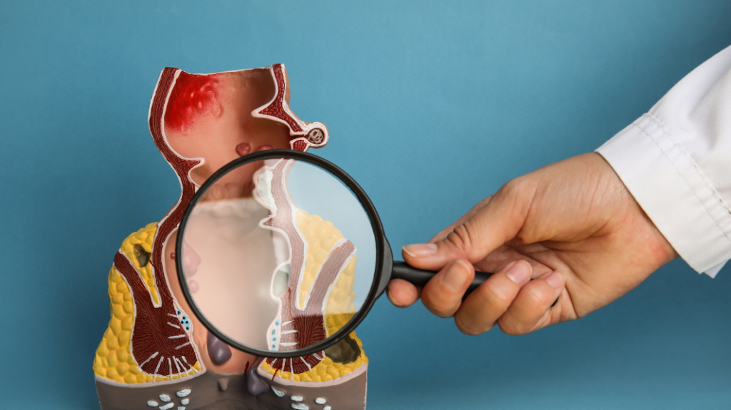 Fistula Treatment
