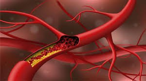 Cholesterol Management at Siddhivinayak Hospital